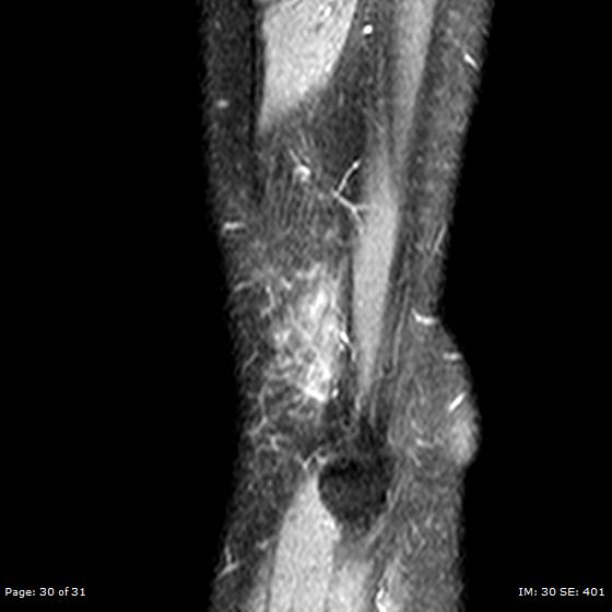 File:Anterior cruciate ligament tear (Radiopaedia 70783-80964 Sagittal STIR 30).jpg