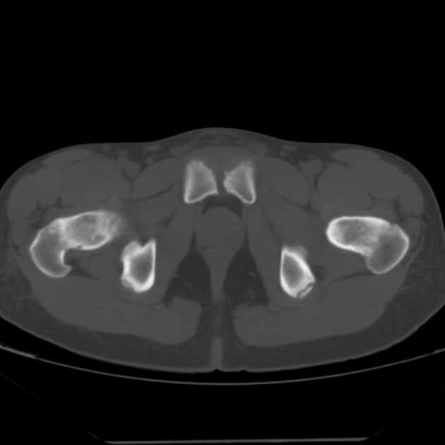 Anterior inferior iliac spine avulsion fracture (Radiopaedia 49469-54627 Axial bone window 49).jpg