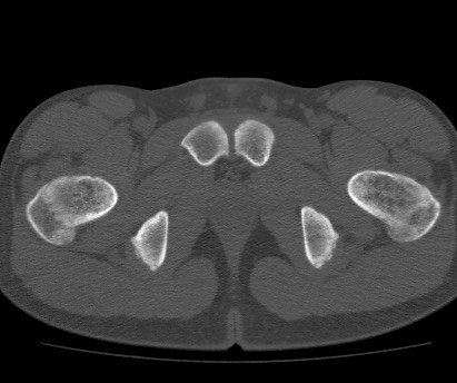 Anterior inferior iliac spine avulsion fracture (Radiopaedia 81312-94999 Axial bone window 64).jpg
