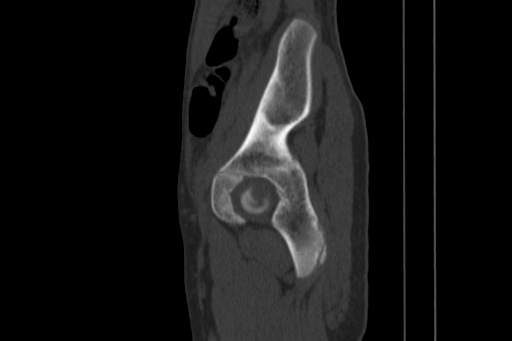 Anterior inferior iliac spine avulsion injury (Radiopaedia 88666-105376 Sagittal bone window 70).jpg
