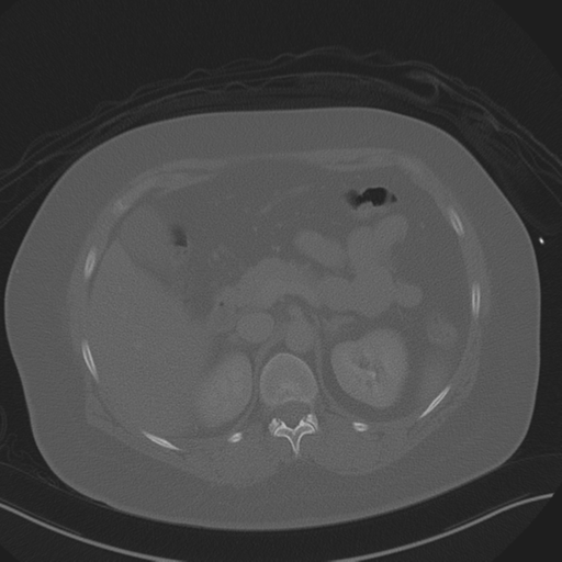 Anterior superior iliac spine avulsion fracture (Radiopaedia 44541-48244 Axial bone window 31).png