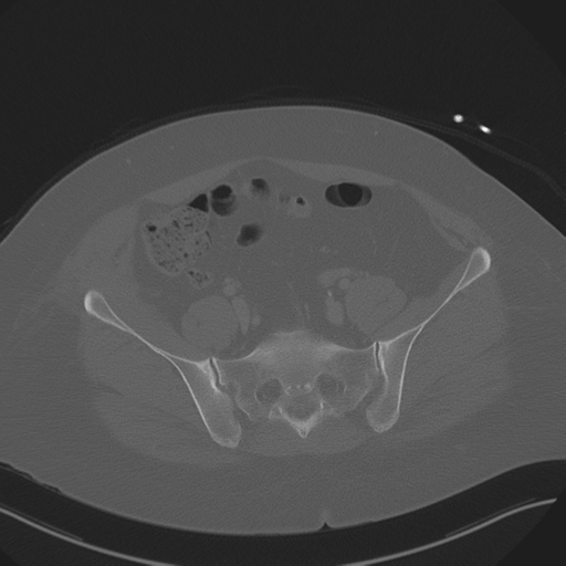 Anterior superior iliac spine avulsion fracture (Radiopaedia 44541-48244 Axial bone window 75).png
