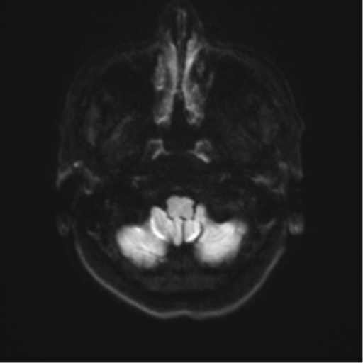 Anterior temporal lobe perivascular space (Radiopaedia 40946-43650 Axial DWI 29).png