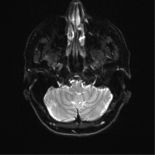 Anterior temporal lobe perivascular space (Radiopaedia 40946-43650 Axial DWI 4).png