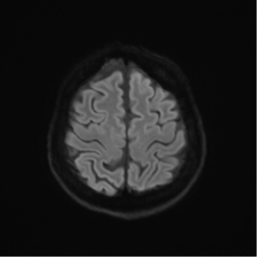 Anterior temporal lobe perivascular space (Radiopaedia 40946-43650 Axial DWI 50).png