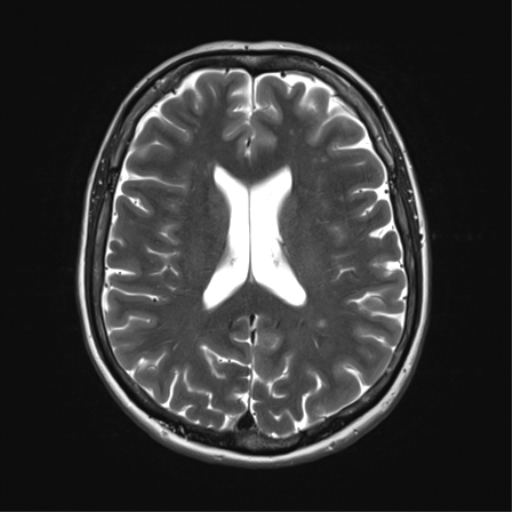 File:Anterior temporal lobe perivascular space (Radiopaedia 40946-43650 Axial T2 23).png