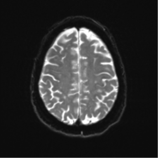 Anterior temporal pole cysts (Radiopaedia 46629-51102 Axial DWI 21).png