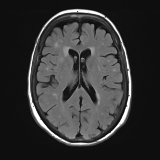 File:Anterior temporal pole cysts (Radiopaedia 46629-51102 Axial FLAIR 16).png