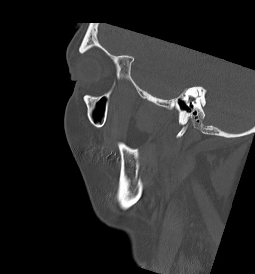 Anterior temporomandibular joint dislocation (Radiopaedia 59430-66784 B 51).jpg