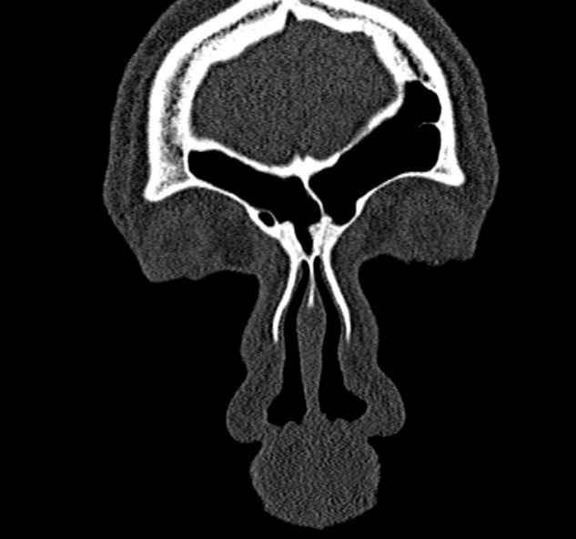 File:Antrochoanal polyp (Radiopaedia 30002-30554 Coronal bone window 13).jpg