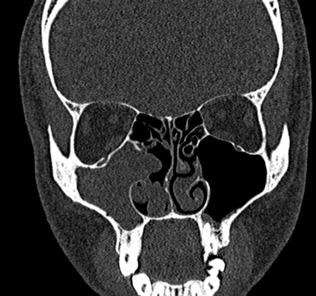 Antrochoanal polyp (Radiopaedia 30002-30554 Coronal bone window 37).jpg