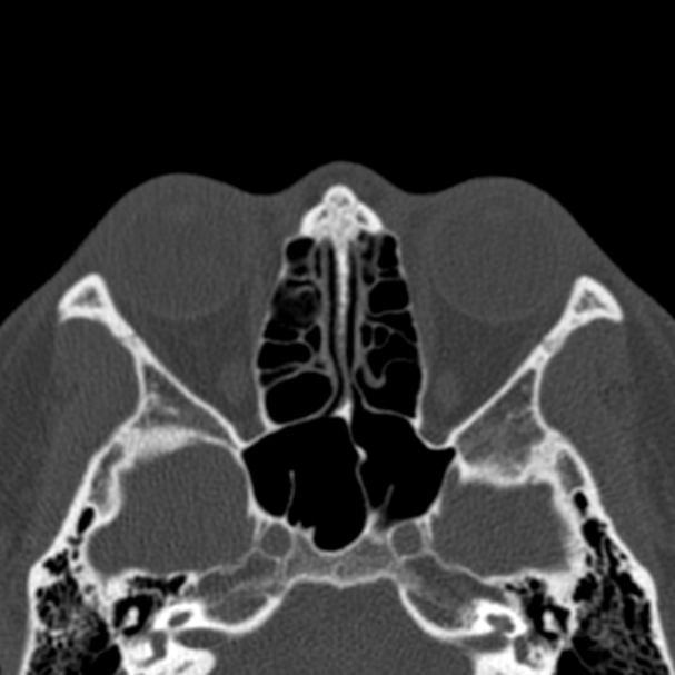 Antrochoanal polyp (Radiopaedia 33984-35202 Axial bone window 49).jpg