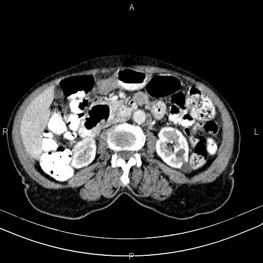 File:Aortic aneurysm and Lemmel syndrome (Radiopaedia 86499-102554 A 40).jpg