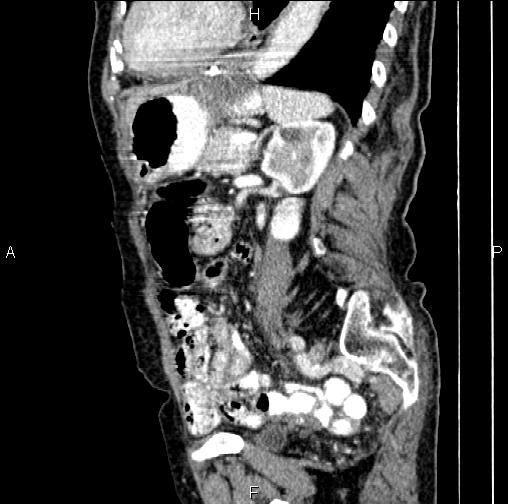 File:Aortic aneurysm and Lemmel syndrome (Radiopaedia 86499-102554 D 59).jpg