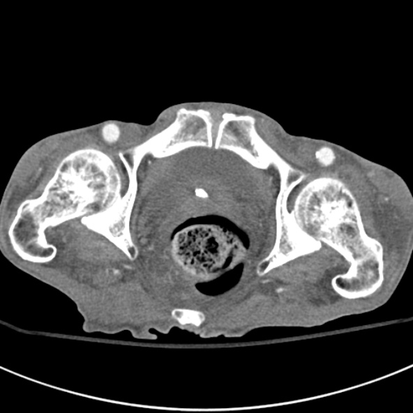 File:Aortic aneurysm with spinal destruction (Radiopaedia 42301-45410 A 111).jpg