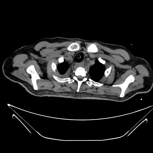 Aortic arch aneurysm (Radiopaedia 84109-99365 Axial non-contrast 37).jpg