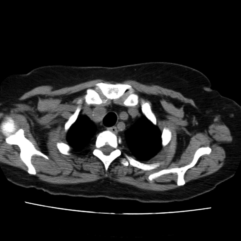 Aortic arch pseudoaneurysm (Radiopaedia 8534-9368 Axial non-contrast 5).jpg