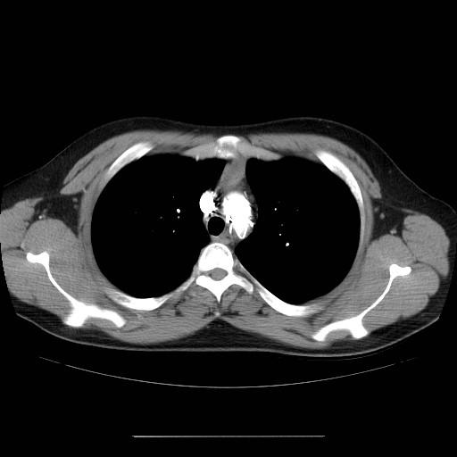 File:Aortic arch stent (Radiopaedia 30030-30595 D 9).jpg