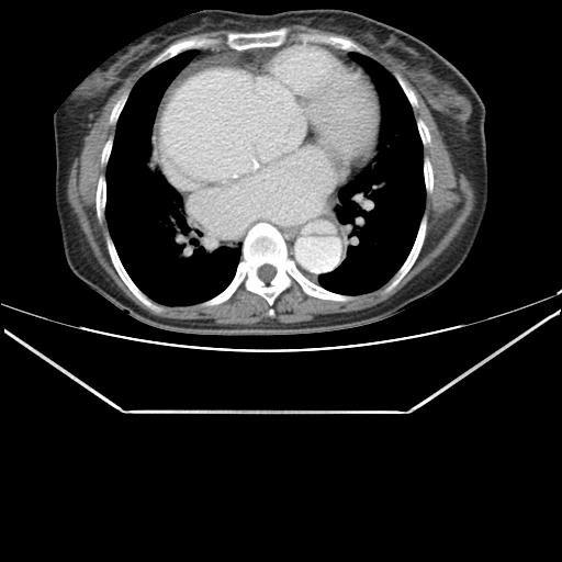 File:Aortic dissection (Radiopaedia 25350-25604 C 29).jpg