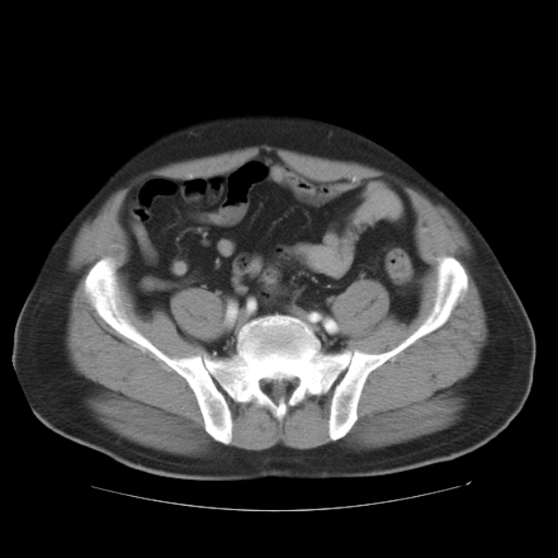 Aortic dissection (Radiopaedia 44411-48061 C 46).jpg