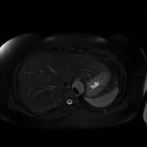 File:Aortic dissection (Radiopaedia 57969-64956 Axial T2 fat sat 15).jpg