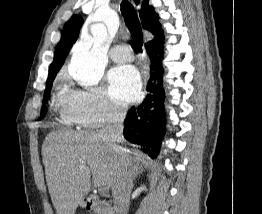 Aortic dissection - Stanford A -DeBakey I (Radiopaedia 28339-28587 C 13).jpg
