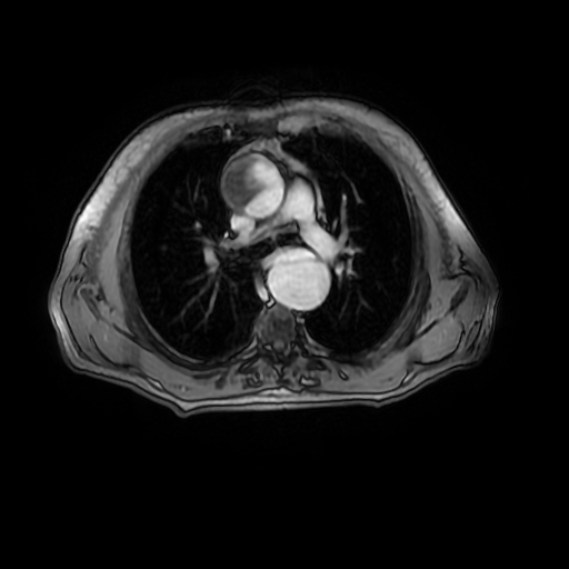 File:Aortic dissection - Stanford A - DeBakey I (Radiopaedia 23469-23551 Axial MRA 13).jpg