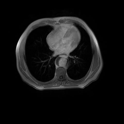 Aortic dissection - Stanford A - DeBakey I (Radiopaedia 23469-23551 Axial MRA 24).jpg