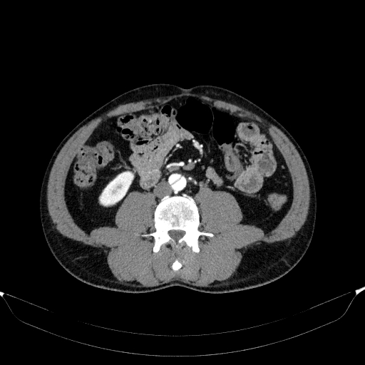 Aortic dissection - Stanford type A (Radiopaedia 83418-98500 A 86).jpg