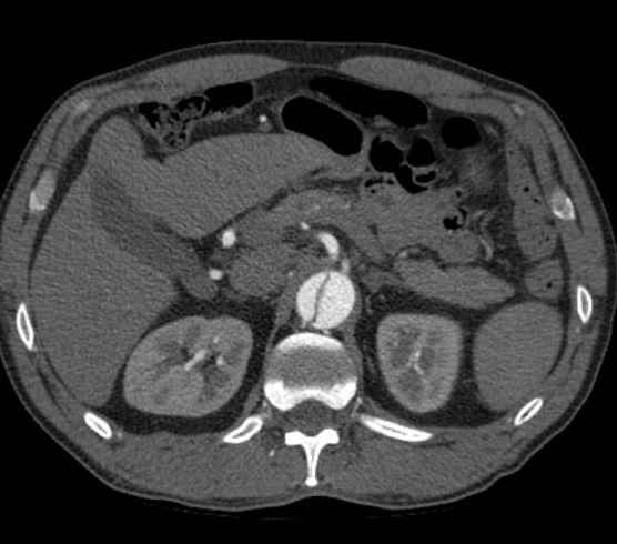 Aortic dissection - Stanford type B (Radiopaedia 73648-84437 A 130).jpg