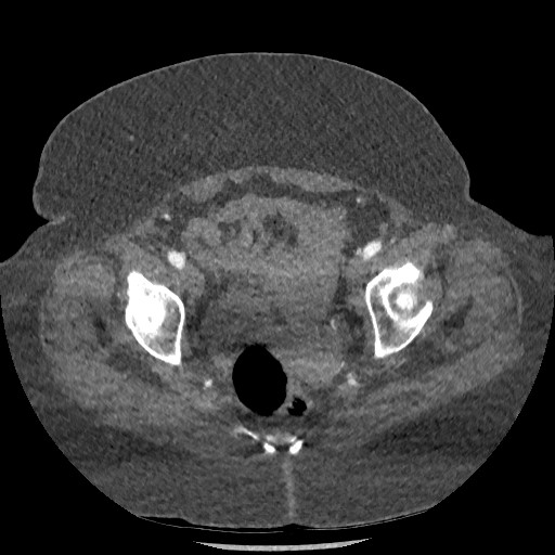 Aortic dissection - Stanford type B (Radiopaedia 88281-104910 A 153).jpg