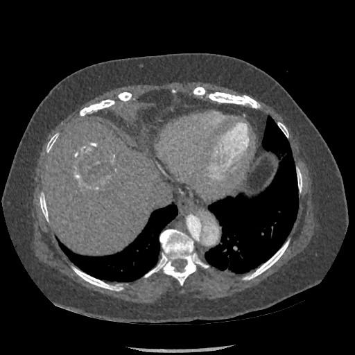 Aortic dissection - Stanford type B (Radiopaedia 88281-104910 A 73).jpg