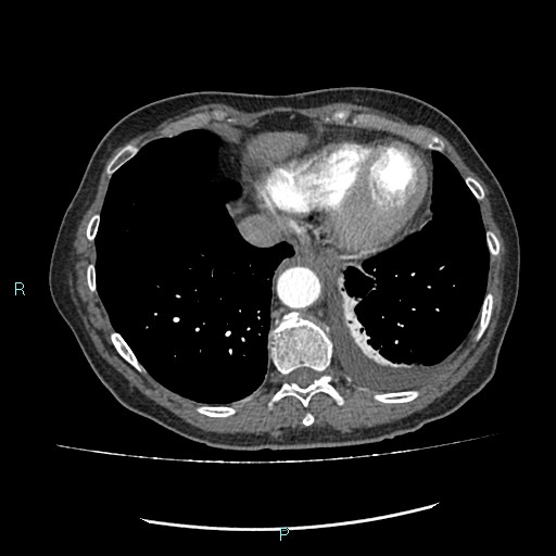 File:Aortic dissection extended to lusory artery (Radiopaedia 43686-47136 B 11).jpg