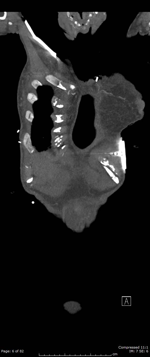 Aortic dissection with extension into aortic arch branches (Radiopaedia 64402-73204 A 6).jpg