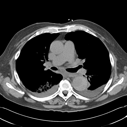 Aortic intramural hematoma (Radiopaedia 34260-35540 Axial non-contrast 29).png