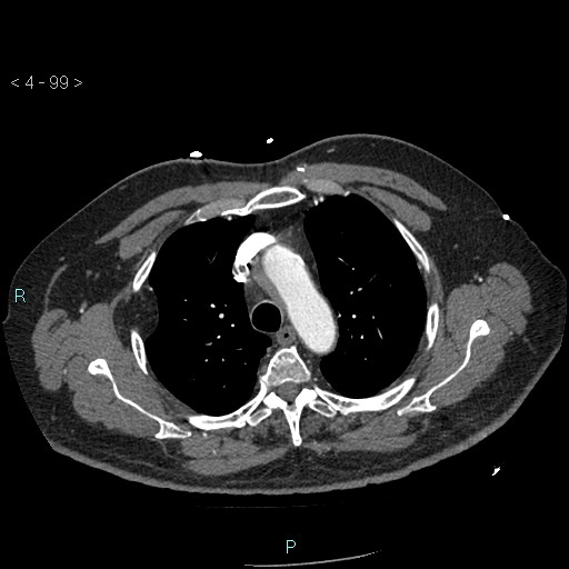 File:Aortic intramural hematoma (Radiopaedia 48463-53380 B 45).jpg