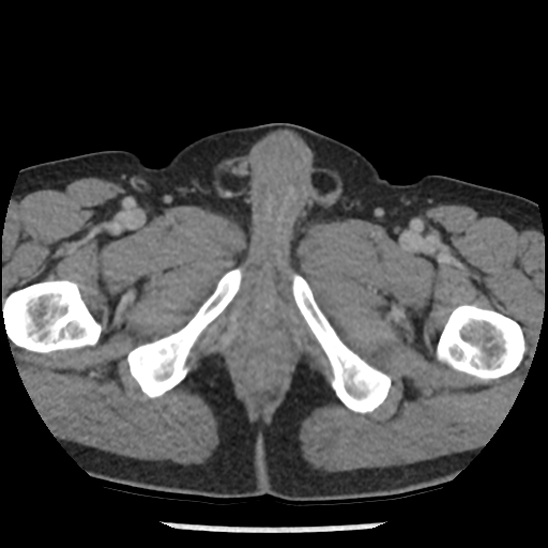 Aortic intramural hematoma (type B) (Radiopaedia 79323-92387 Axial C+ delayed 122).jpg