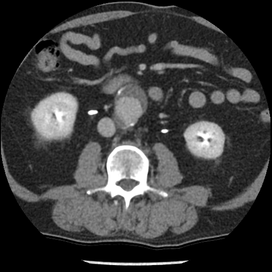File:Aortic intramural hematoma (type B) (Radiopaedia 79323-92387 Axial C+ delayed 75).jpg