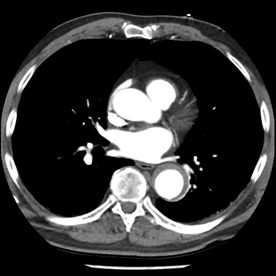 File:Aortic intramural hematoma (type B) (Radiopaedia 79323-92387 B 30).jpg