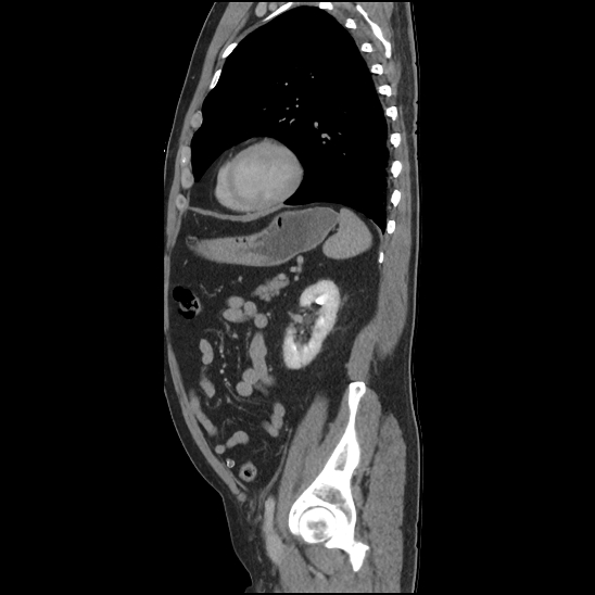 Aortic intramural hematoma (type B) (Radiopaedia 79323-92387 Sagittal C+ delayed 40).jpg