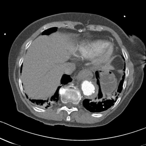 Aortic intramural hematoma from penetrating atherosclerotic ulcer (Radiopaedia 31137-31836 A 64).jpg