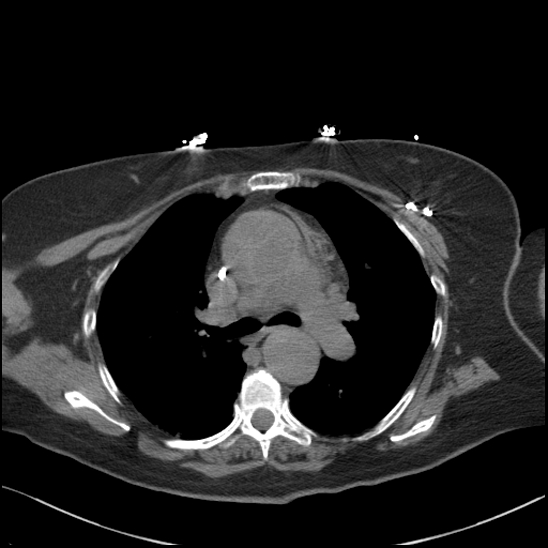 File:Aortic intramural hematoma with dissection and intramural blood pool (Radiopaedia 77373-89491 Axial non-contrast 39).jpg