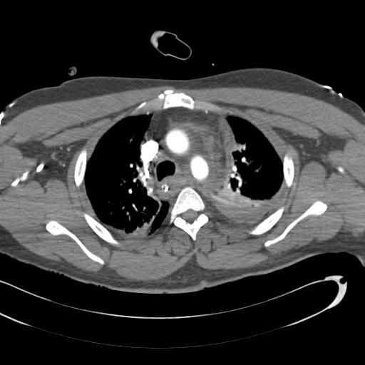Aortic transection, diaphragmatic rupture and hemoperitoneum in a complex multitrauma patient (Radiopaedia 31701-32622 A 30).jpg