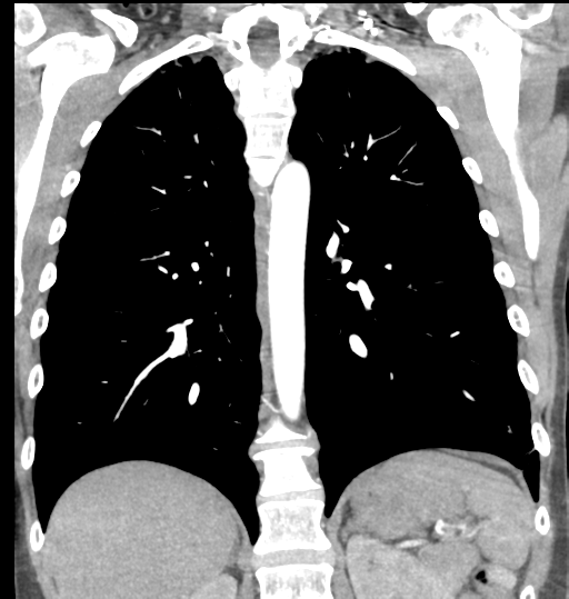 File:Aortic valve non-coronary cusp thrombus (Radiopaedia 55661-62189 C 52).png