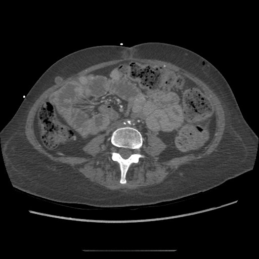 Aorto-duodenal fistula (Radiopaedia 25668-25850 A 47).jpg