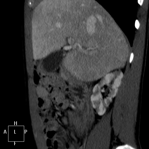 File:Aorto-left renal vein fistula (Radiopaedia 45534-49628 C 5).jpg