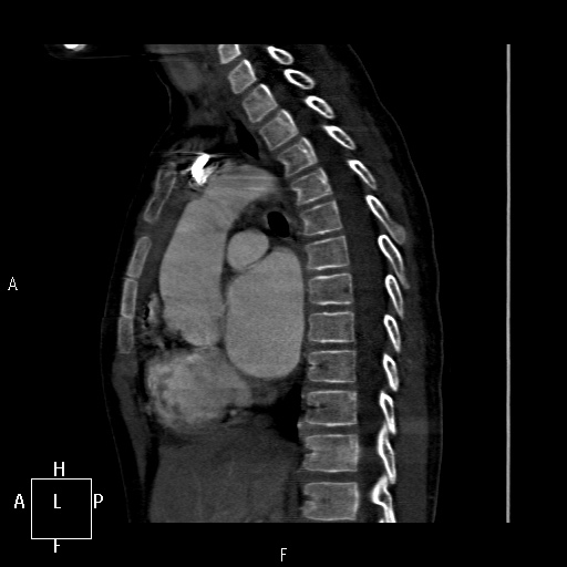 File:Aortopulmonary septal defect (Radiopaedia 41990-45013 Sagittal C+ CTPA 28).jpg