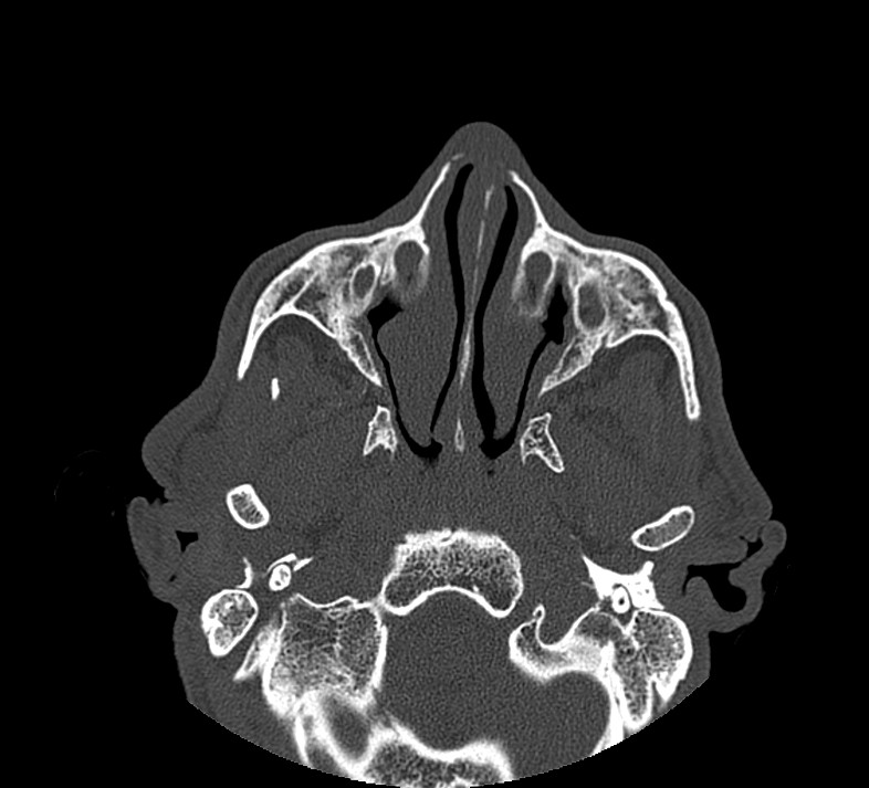 Aplastic maxillary sinuses (Radiopaedia 60030-67561 Axial non-contrast 30).jpg