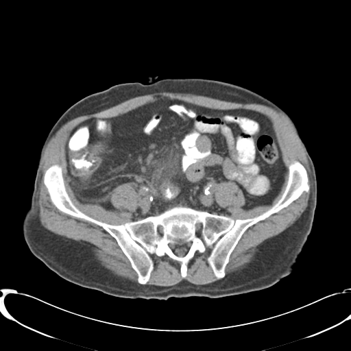 File:Appendiceal abscesses (Radiopaedia 50999-56542 Axial non-contrast 57).png