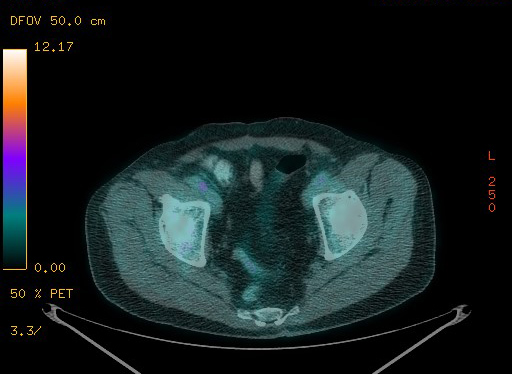 Appendiceal adenocarcinoma complicated by retroperitoneal abscess (Radiopaedia 58007-65041 Axial PET-CT 178).jpg